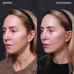 Facelift Vorher-Nachher-Ergebnis bei VG Plastic Surgery – sichtbare Verjüngung nach 2 Wochen