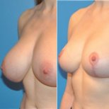 Vorher-nachher-Ergebnis Brustverkleinerung bei Private Yüzyıl Hospital, verbesserte Form