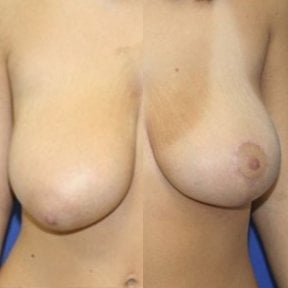 Vorher-nachher-Ergebnis Brustverkleinerung in Private Yüzyıl Hospital, verbesserte Form