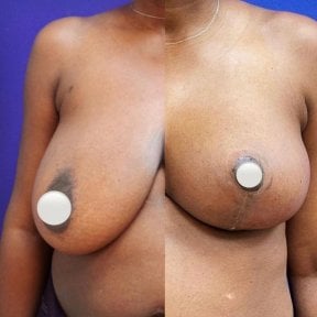 Vorher-nachher-Ergebnis Brustverkleinerung bei Private Yüzyıl Hospital, verbesserte Kontur