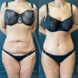 Vorher-nachher Mommy Makeover bei Liv Hospital Ulus – sichtbare Bauchkontur-Verbesserung