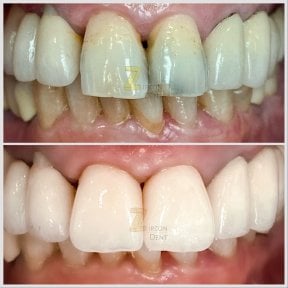 Vorher-nachher-Ergebnis der Zahnkroneninstallation bei Smile Centrum, sichtbare Verbesserung