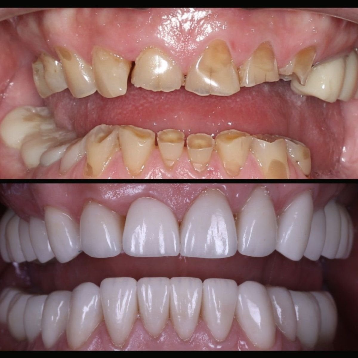 Antes y después de la colocación de coronas dentales en Smile Centrum: dientes restaurados