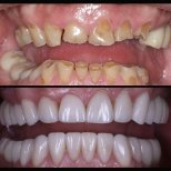 Vorher-nachher-Ergebnis Zahnkronen bei Smile Centrum – restaurierte Zähne und schönes Lächeln