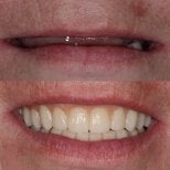Vorher-nachher-Ergebnis All-on-4 Zahnimplantate bei Smile Centrum, vollständiges Lächeln