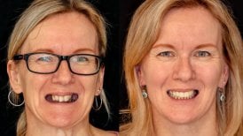 Vorher-nachher-Ergebnis All-on-4-Implantate bei Smile Centrum – vollständige Zahnsanierung