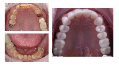 Vorher-nachher-Ergebnisse der Zahnkroneninstallation bei Smile Centrum, verbesserte Zähne