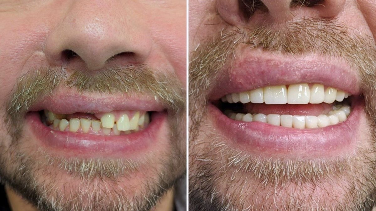 نتائج قبل وبعد تركيب تيجان الأسنان في Smile Centrum، تحسين مظهر الابتسامة