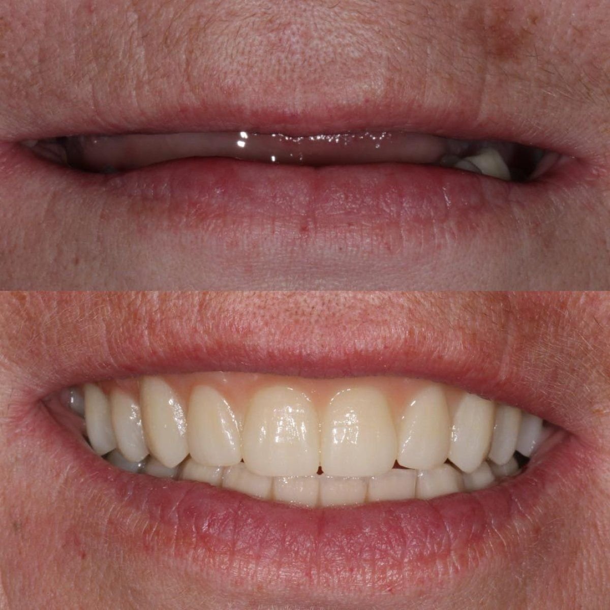 نتائج قبل وبعد تركيب تيجان الأسنان في Smile Centrum، تحسين مظهر الابتسامة