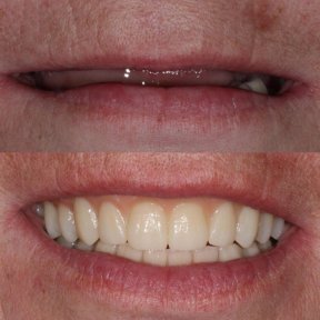 Vorher-nachher-Ergebnis Zahnkronen bei Smile Centrum, verbesserte Ästhetik des Lächelns