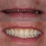 Vorher-nachher-Ergebnis Zahnkronen bei Smile Centrum, verbesserte Ästhetik des Lächelns