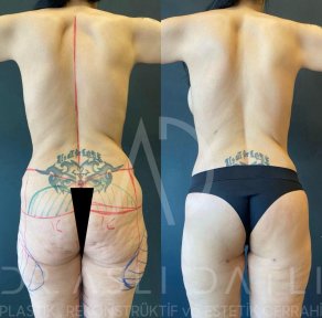 Vorher-nachher-Ergebnis Brazilian Butt Lift bei Liv Hospital Ulus, verbesserte Gesäßform