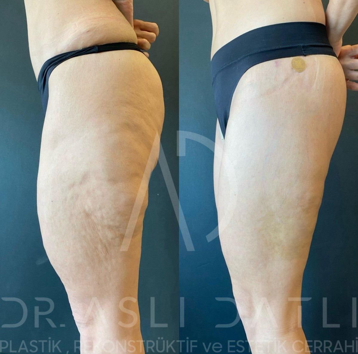 Vorher-nachher Brazilian Butt Lift bei Liv Hospital Ulus, glattere Kontur und straffere Gesäßform