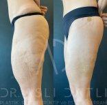 Vorher-nachher Brazilian Butt Lift bei Liv Hospital Ulus, glattere Kontur und straffere Gesäßform