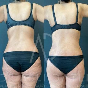 Vorher-nachher-Ergebnisse Brazilian Butt Lift bei Liv Hospital Ulus, verbesserte Kontur