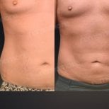 Before and after Vaser liposuction results at Memorial Bahçelievler Hospital, abdomen contour