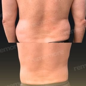 Before and after Vaser liposuction results at Memorial Bahçelievler Hospital, back contouring