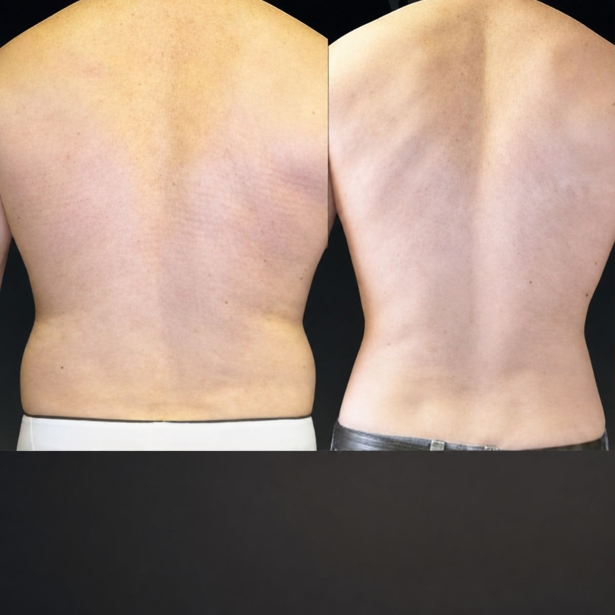 Resultados antes y después de liposucción Vaser en la espalda en Memorial Bahçelievler Hospital
