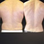 Before and after Vaser liposuction results at Memorial Bahçelievler Hospital, back contouring