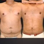 Before and after Vaser liposuction results at Memorial Bahçelievler Hospital, abdomen contour