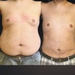 Before and after Vaser liposuction results at Memorial Bahçelievler Hospital, abdomen contour