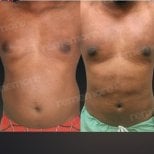 Before and after Vaser liposuction results at Memorial Bahçelievler Hospital, body contouring