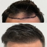 نتائج زراعة الشعر قبل وبعد في مستشفى ميموريال أنطاليا، استعادة خط الشعر للرجال