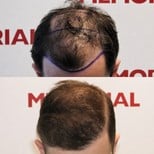 نتائج زراعة الشعر قبل وبعد في مستشفى ميموريال أنطاليا، استعادة خط الشعر للرجال