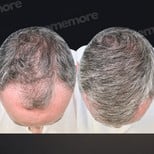 نتائج زراعة الشعر قبل وبعد في مستشفى ميموريال أنطاليا، كثافة شعر محسنة