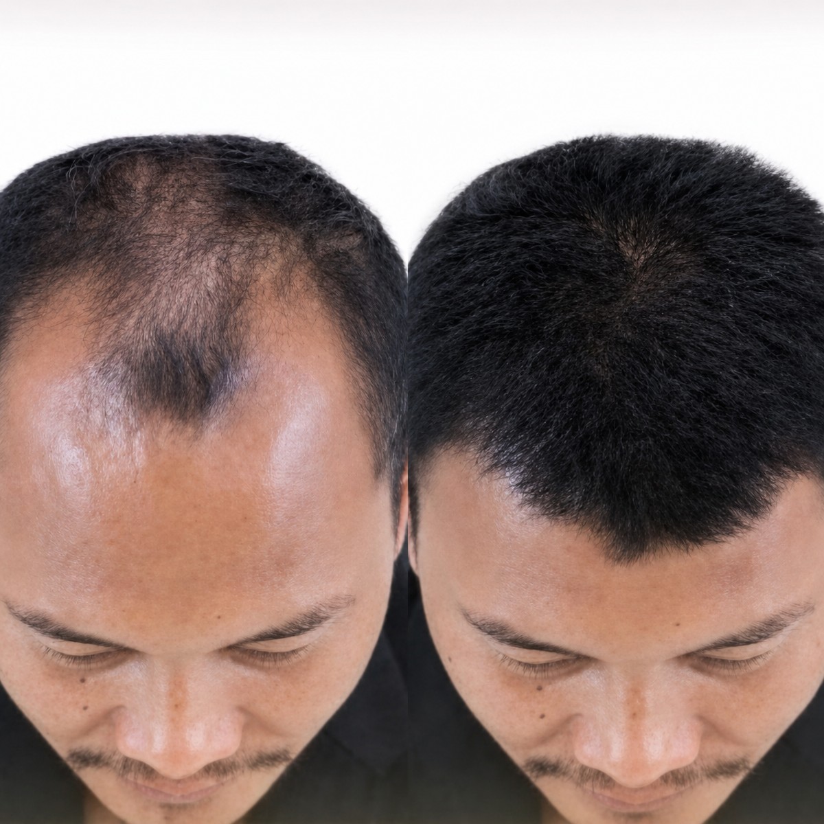 نتائج زراعة الشعر قبل وبعد في مستشفى ميموريال أنطاليا، استعادة خط الشعر للرجال