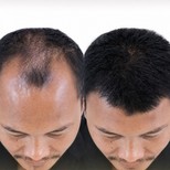 نتائج زراعة الشعر قبل وبعد في مستشفى ميموريال أنطاليا، استعادة خط الشعر للرجال