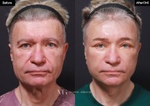 Before and after lower eyelid blepharoplasty results at VG Plastic Surgery, reduced eye bags