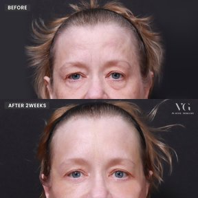 Lower eyelid blepharoplasty before and after results at VG Plastic Surgery, reduced eye bags