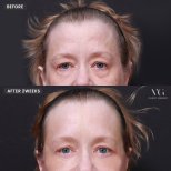 Lower eyelid blepharoplasty before and after results at VG Plastic Surgery, reduced eye bags