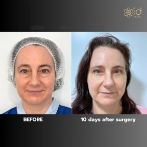 Before and after blepharoplasty results at ID Clinic Bangkok, eyelid correction improvement