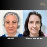 Before and after blepharoplasty results at ID Clinic Bangkok, eyelid correction improvement