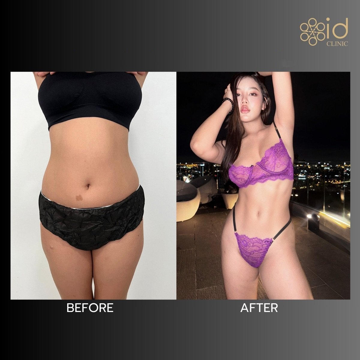 Vorher-nachher-Ergebnis der Vaser-Liposuktion bei ID Clinic Bangkok, schlankere Taille