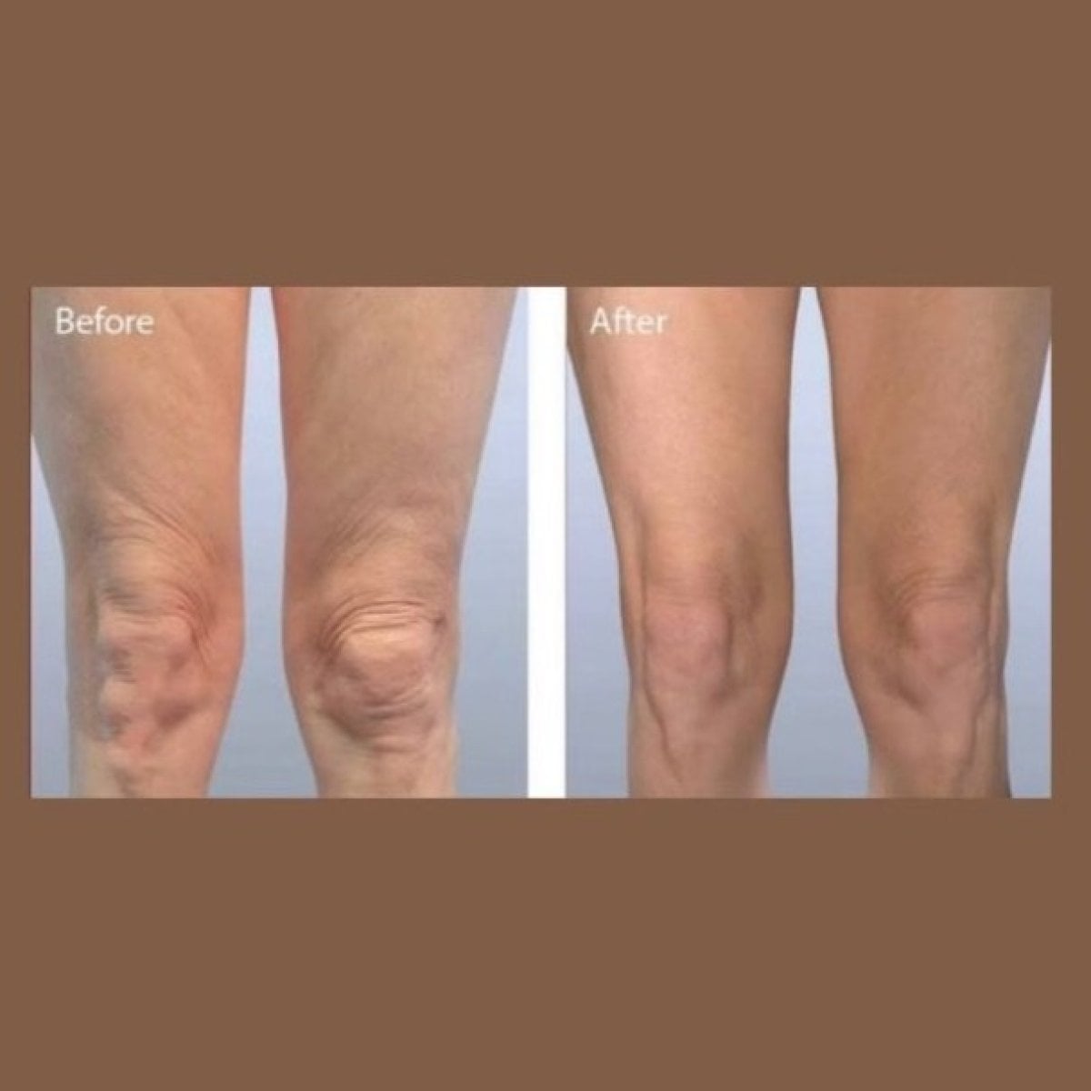 Resultados antes y después de Morpheus8 reafirmante de piernas en ID Clinic Bangkok