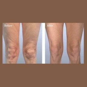 Before and after Morpheus8 skin tightening results on legs at ID Clinic Bangkok