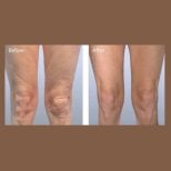 Before and after Morpheus8 skin tightening results on legs at ID Clinic Bangkok