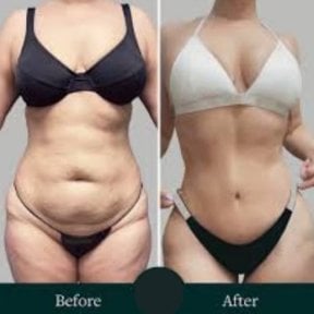 Before and after Morpheus8 skin tightening results at ID Clinic Bangkok, improved body contour