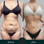 Before and after Morpheus8 skin tightening results at ID Clinic Bangkok, improved body contour