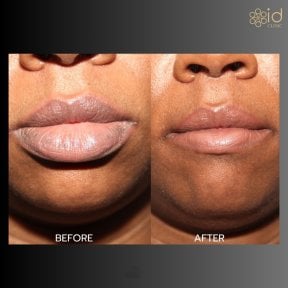 Before and after lip reduction results at ID Clinic Bangkok, visibly slimmer lips after procedure