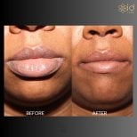 Before and after lip reduction results at ID Clinic Bangkok, visibly slimmer lips after procedure