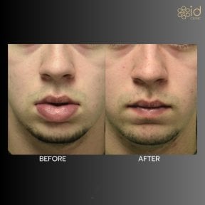 Before and after lip reduction results at ID Clinic Bangkok, visible slimmer lips transformation