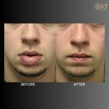 Before and after lip reduction results at ID Clinic Bangkok, visible slimmer lips transformation