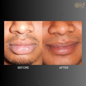 Before and after lip reduction results at ID Clinic Bangkok, visible slimmer lips transformation