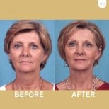 Facelift before and after results at ID Clinic Bangkok, visible facial rejuvenation and lift