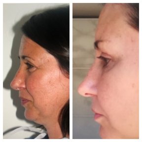 Before and after facial fat transfer at Clinica Granado Tiagonce, visible facial contour result