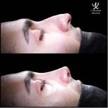 نتائج تجميل الأنف قبل وبعد في مستشفى ميديبول أكيبديم، تحسين شكل الأنف